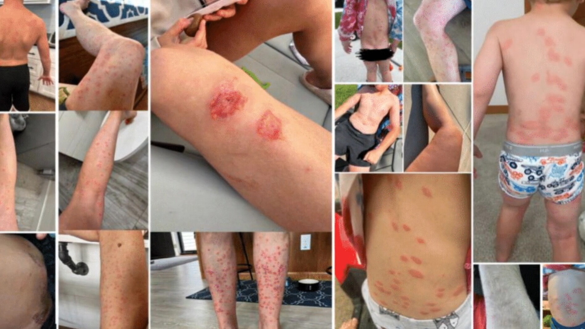 Swimmers Rash Lake 'They're terrified of the water': Swimmer’s itch at Pelican Lake in ...