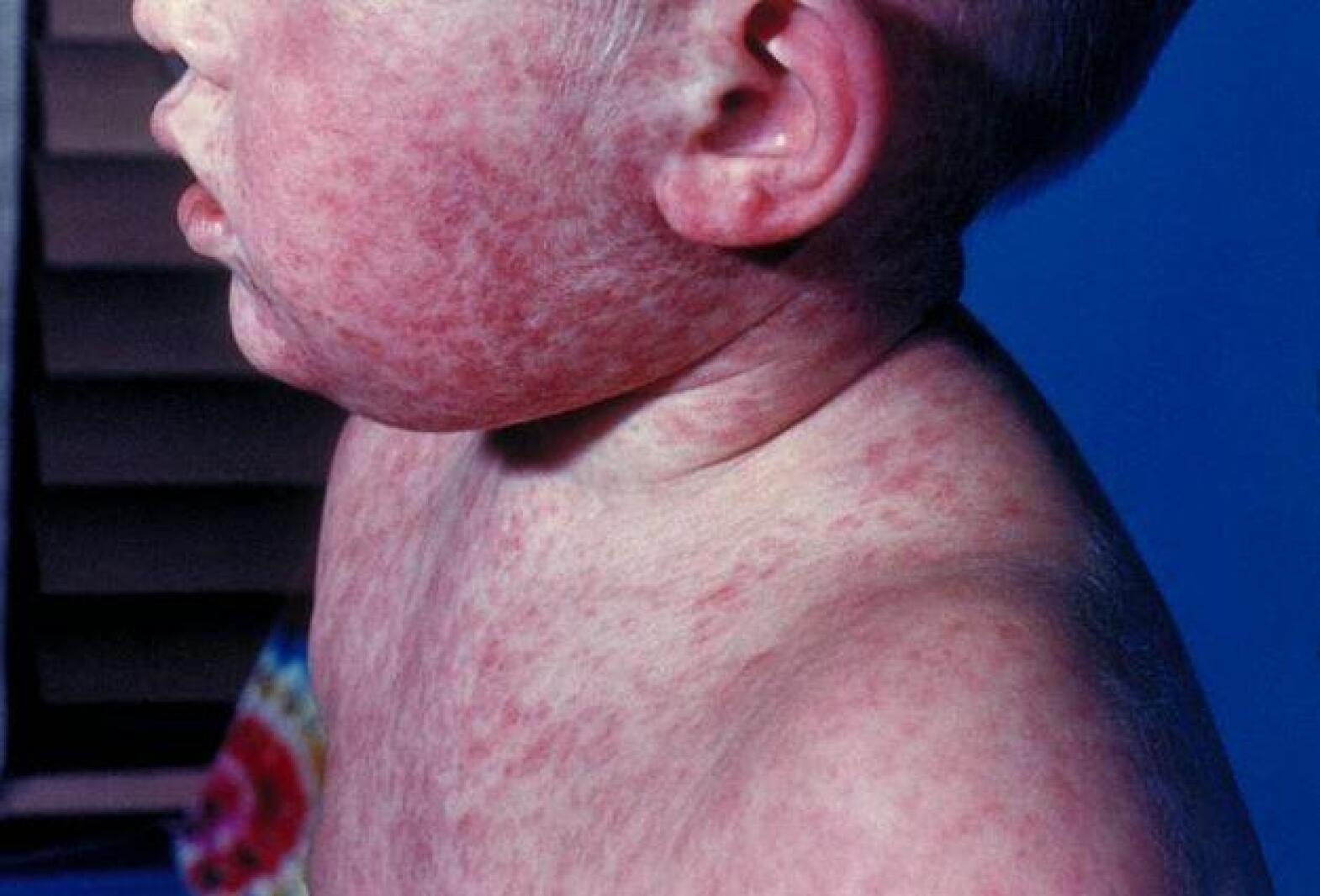 Burke becomes 4th North Dakota county to report measles