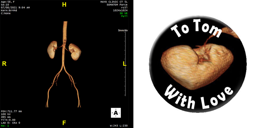 LindaChristophersonkidney.png