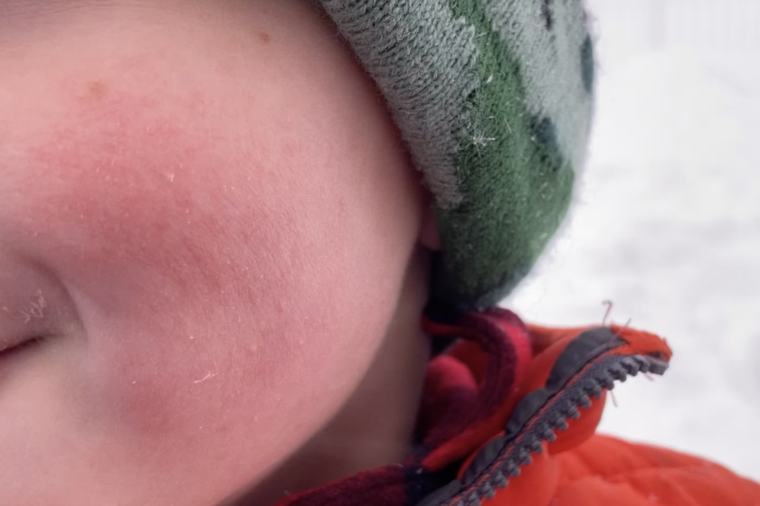 Some People Are Actually Allergic to Cold Weather Some People Are Actually Allergic to Cold Weather