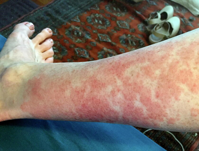 Ramblers Rash Why hiker's rash happens, and how to make it less likely - InForum ...