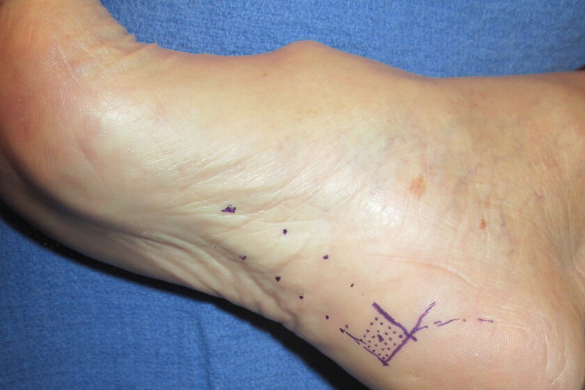 Health Fusion: Fat injections for foot pain - Duluth News Tribune ...