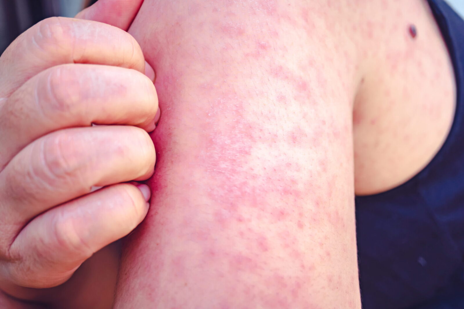 Wrestling Rashes SDDOH warns of potential measles exposure at Brookings wrestling ...