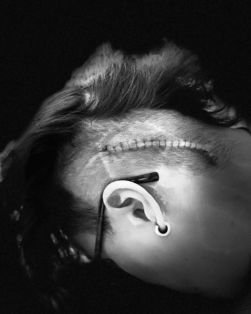 Amy Abts brain surgery 2020.jpg