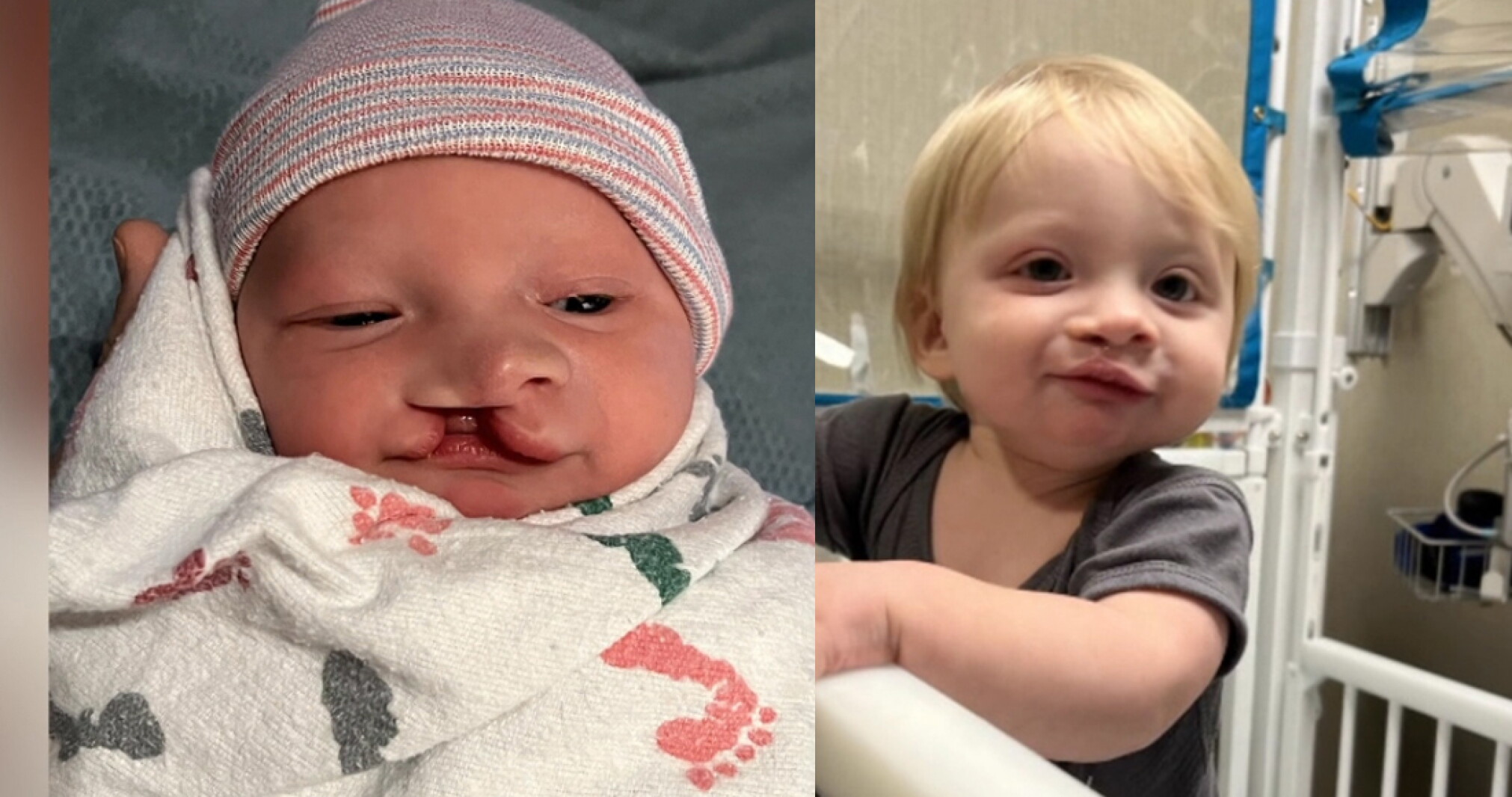 Tucker's smile: Fargo family shares journey to normalize cleft conditions