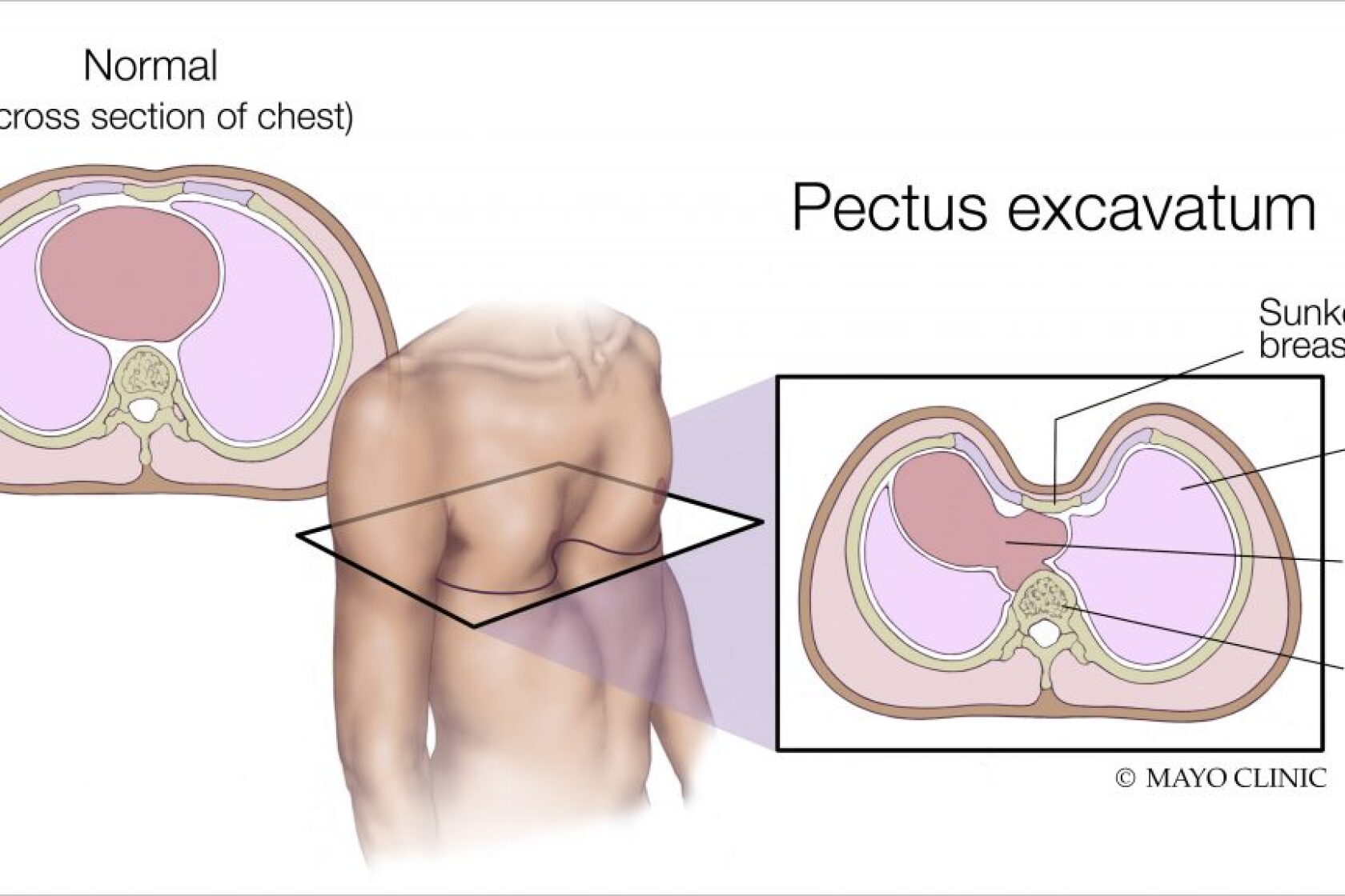 Pectus Types Mayo Clinic Q&A: Understanding and treating pectus excavatum
