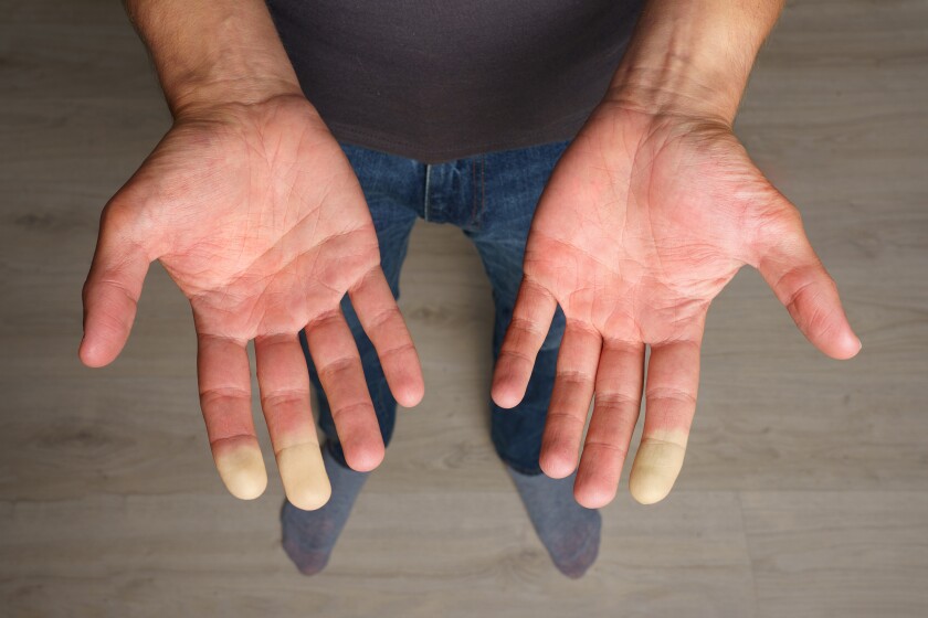 LIFE-HEALTH-RAYNAUDS-DMT